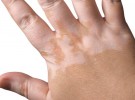 vitiligo-u-deti.jpg - kopie